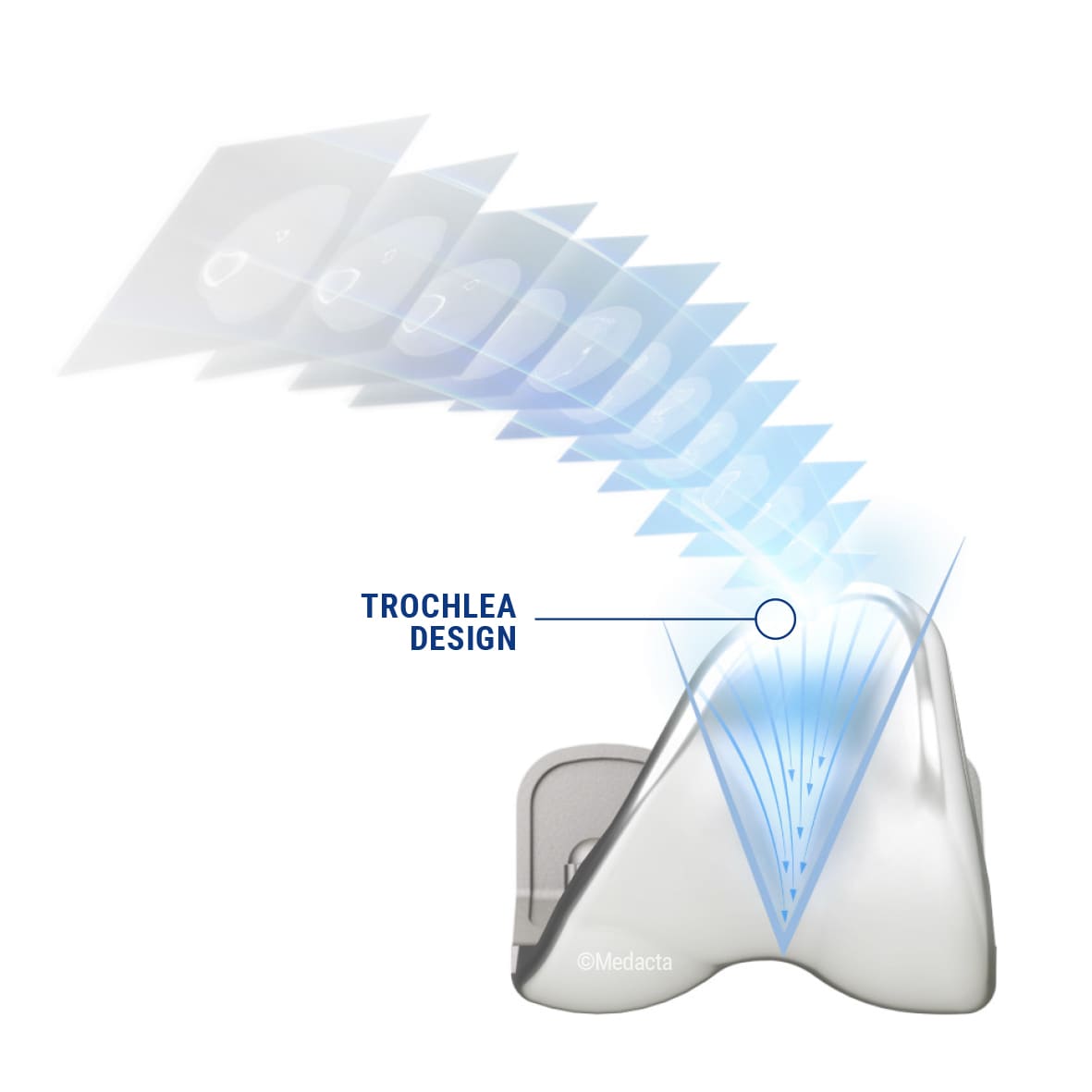 The GMK SpheriKA funnel-shaped trochlea groove