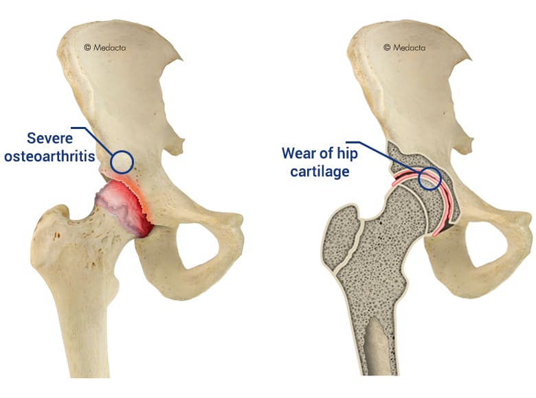 hip anatomy