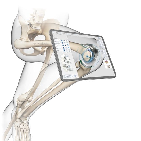 MyKnee®
