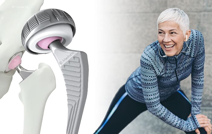 hip replacement